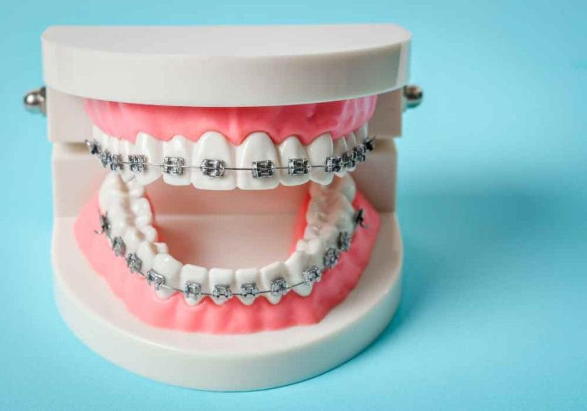 braces in a tooth model